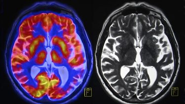 hjernen fMRI skanning neurovidenskab neuroner aktivitet
