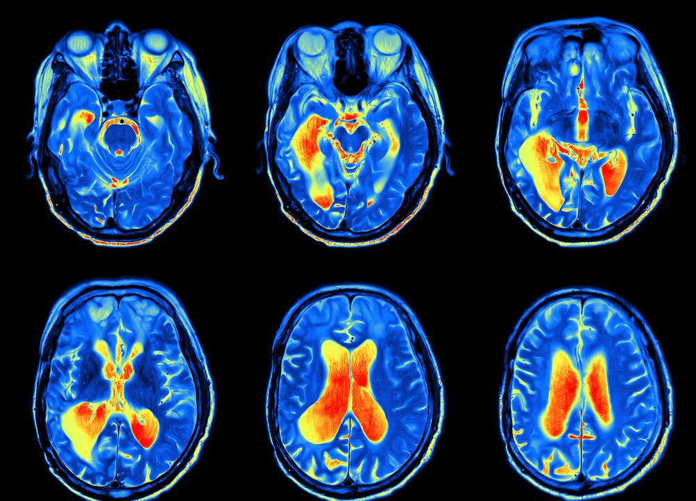 fMRI hjerneskanning neurovidenskab algoritme metodefejl