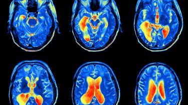 fMRI hjerneskanning neurovidenskab algoritme metodefejl