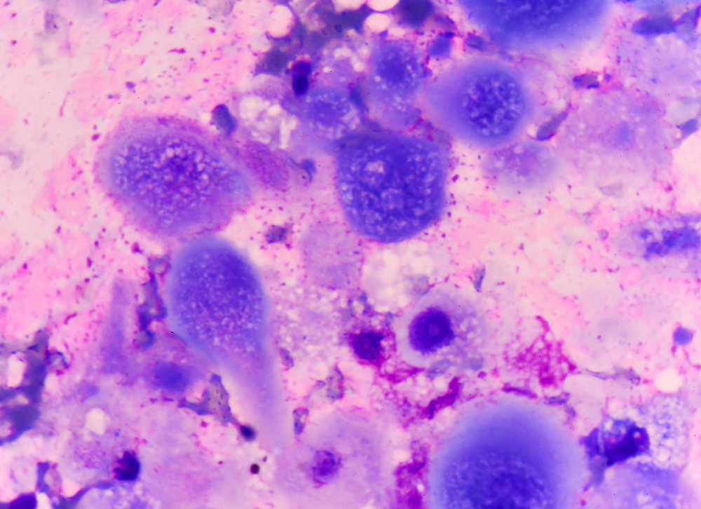 Kræft cancer malariavaccine sukker på overfladen