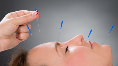 Akupunktur placebo