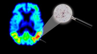 demens tau-protein amyloid-protein kognitiv svækkelse Alzheimer forskning PET-scanning ophobning lægemidler effekt diagnose hjernescanning