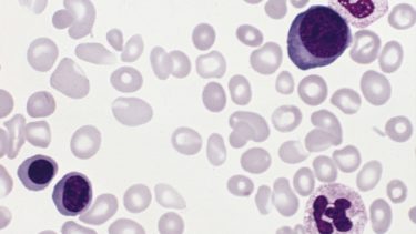 roede_blodlegemer_ilt_polycythaemia_vera