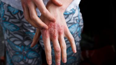 autoimmune sygdomme psoriasis