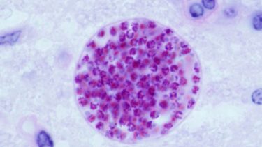 Kat parasit toxoplamose haresyge graviditet risiko smitte overføre grøntsager råt kød katteafføring katteurin  betændelsestilstande epilepsi Alzheimers sygdom kræft