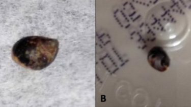 Når strandsnegle suger sig fast, kan de holde fugten inde i sneglehuset. På den måde kan de overleve i tidevandszoner - eller knæ og albuer. (Foto: BMJ Case Reports)