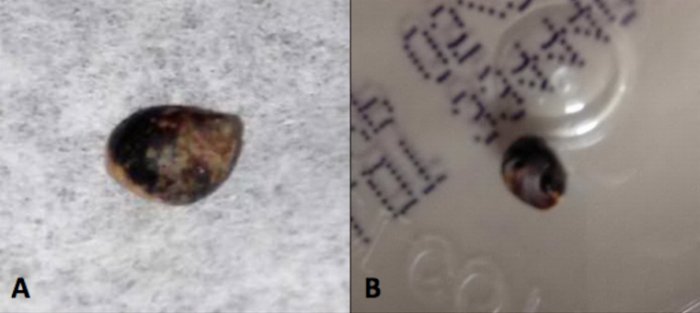 Når strandsnegle suger sig fast, kan de holde fugten inde i sneglehuset. På den måde kan de overleve i tidevandszoner - eller knæ og albuer. (Foto: BMJ Case Reports)