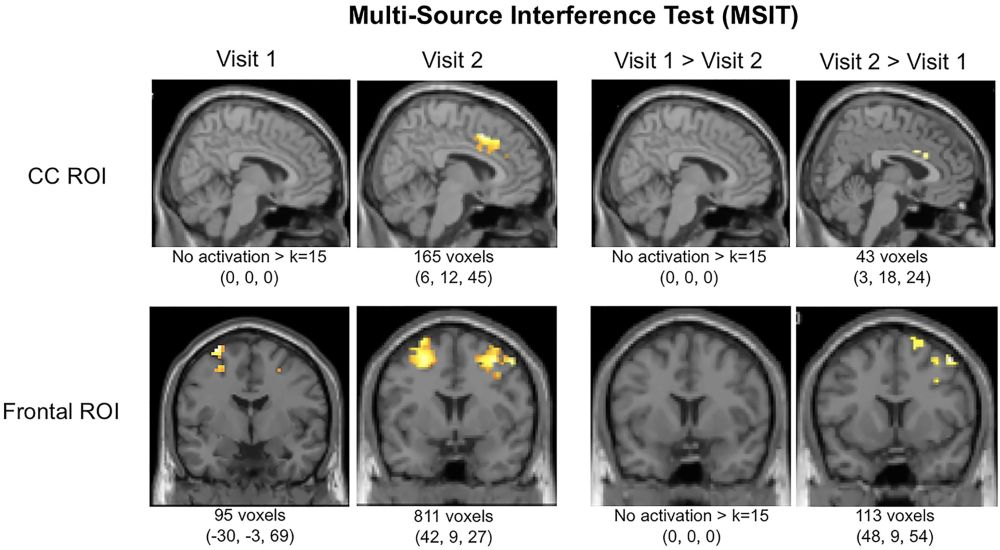 Hjerneskanning, fMRI, cingulate cortex, medicinsk cannabis, forskning, hjernen, depression, angst, opioider, smerte