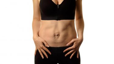 rectus diastase skilte mavemuskler graviditet fysioterapi fødsel transversus- og coretræning øvelser navle mave midte kløft bule træning