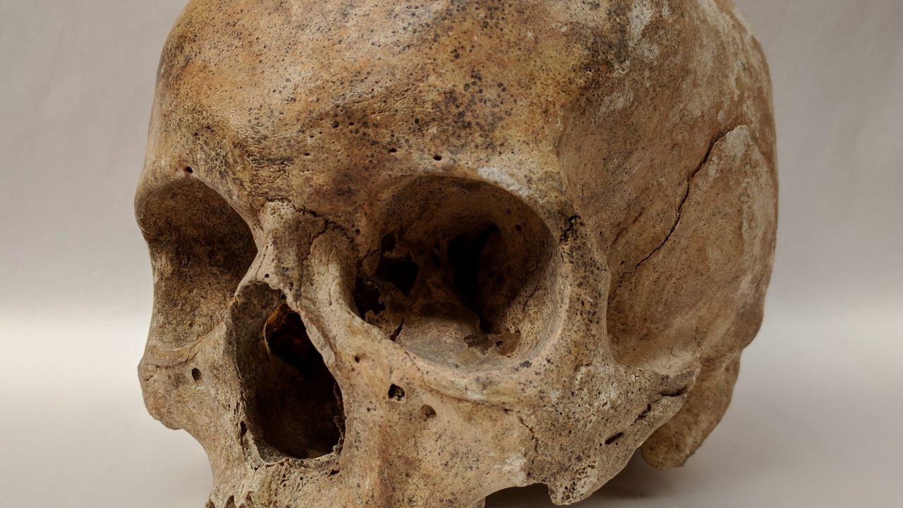 spedalskhed arkæologi knogler sygdomme
