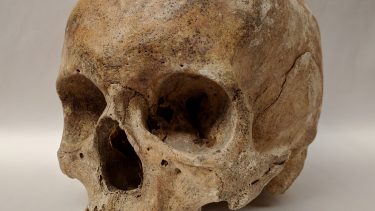 spedalskhed arkæologi knogler sygdomme