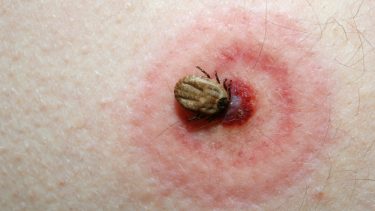 borrelia bborrelia_burgdorferi_flaatbid_borrelia_neruroborreliose_sygdom_nervesystemet
