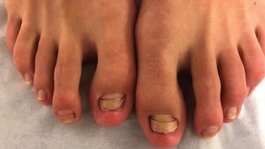 fiskespa fiskepedicure kvinde miste tånegle