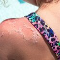 Et nærbillede af en solbrændt skulder med afskallet hud, iført en farverig badedragt med leopardprint ved en lys, klar pool.