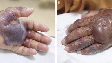 Vibrio vulnificis havkolera infektion bakterie skaldyr seafood