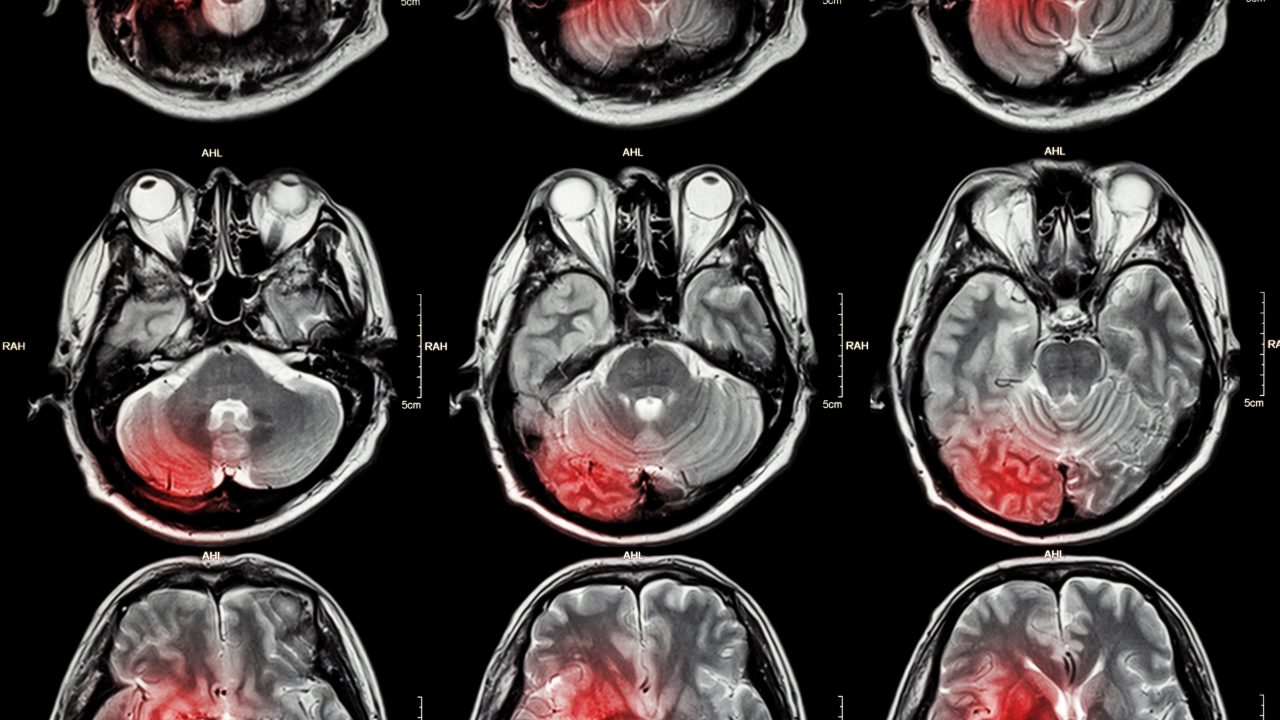 hjerne tumor gliobastom immunterapi kræftvaccine skræddersyet behandling