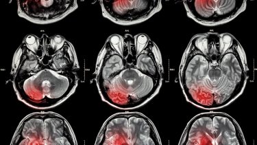 hjerne tumor gliobastom immunterapi kræftvaccine skræddersyet behandling