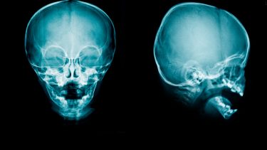 hydrocephalus protein farmakologisk intervention medicin behandling NKCC1 behandling bumetanid cerebrospinalvæske Choroid plexus cellemembran
