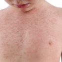 Mæslinge udbrud vaccine Danmark børn