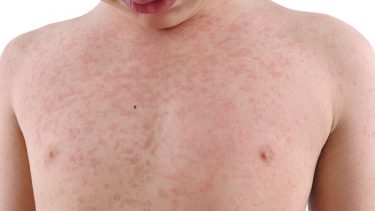 Mæslinge udbrud vaccine Danmark børn