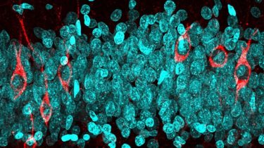 Alzheimer neurogenese hjerneceller produktion reduktion neuroner hjernevæv gyrus dentatus hippocampus fiksering formaldehyd patienter  diagnose celledannelse