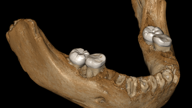 virtual-reconstruction-of-the-xiahe-mandible