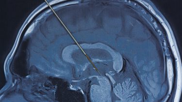 Hjerne elektroder kirurgi indgreb depression behandlingsmetode Parkinsons sygdom bipolar II Dyb hjernestimulering effekt resultater fund elektrochokbehandling terapi behandlingsresistente subgenuale cingulum Brodmann area 25