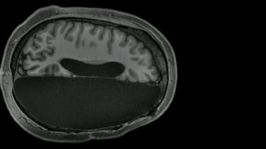 hjerne_epilepsi_operation_