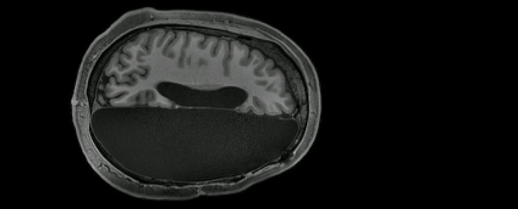 hjerne_epilepsi_operation_