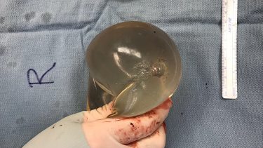 bryst implantat kugle skud videnskab silikone