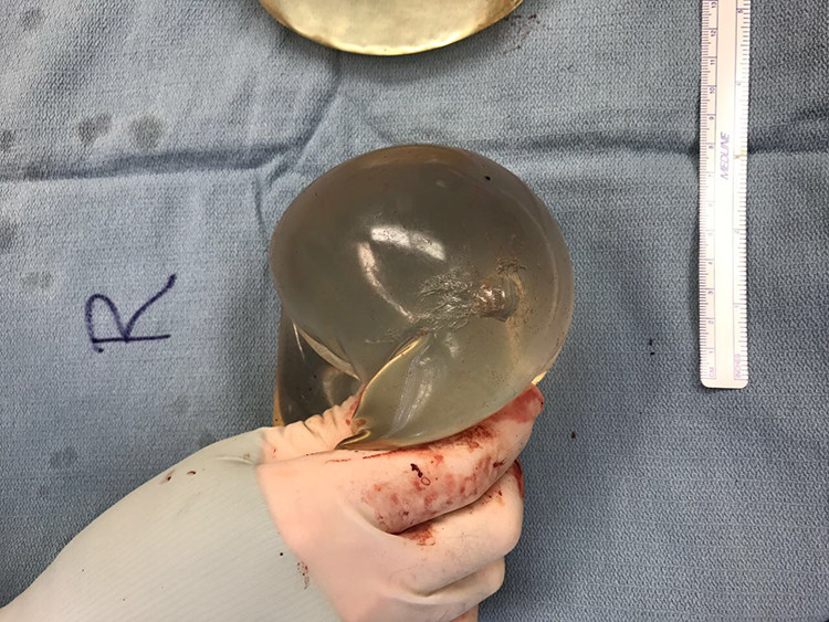 bryst implantat kugle skud videnskab silikone