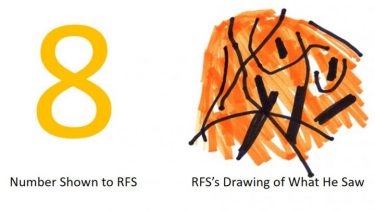RFS patient mand ser tal som kruseduller