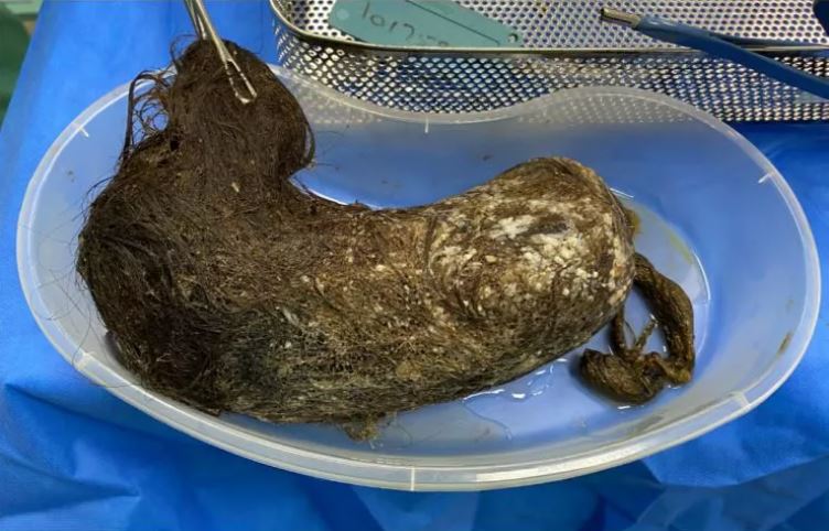 Hårbolle Syndrom Forstyrrelse