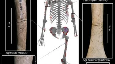 Hajangreb 3000 år siden Japan Mand