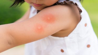 Myggestik myg immunitet spyt reaktion histamin antihistamin