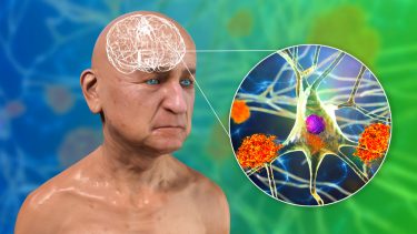 Ældre med Alzheimers amyloide plaques i hjernen