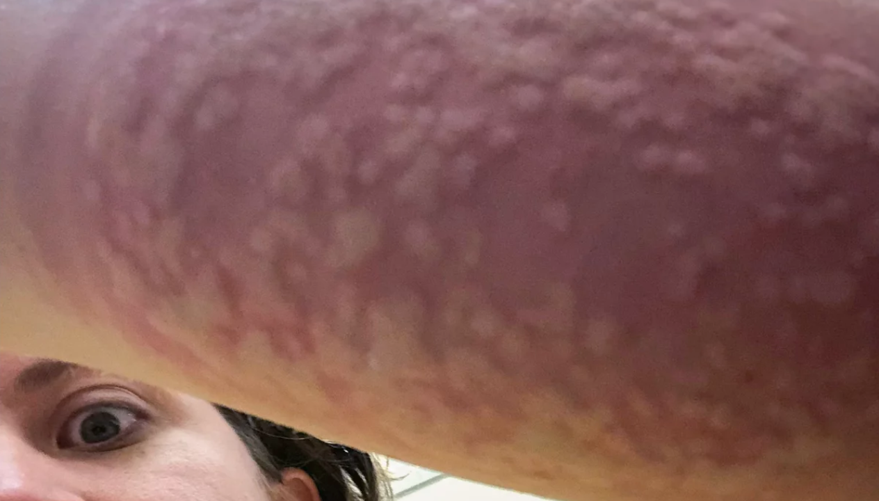 carolina reids arm der er stukket af 200 myg