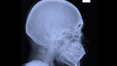 kranie xray hjernerystelse