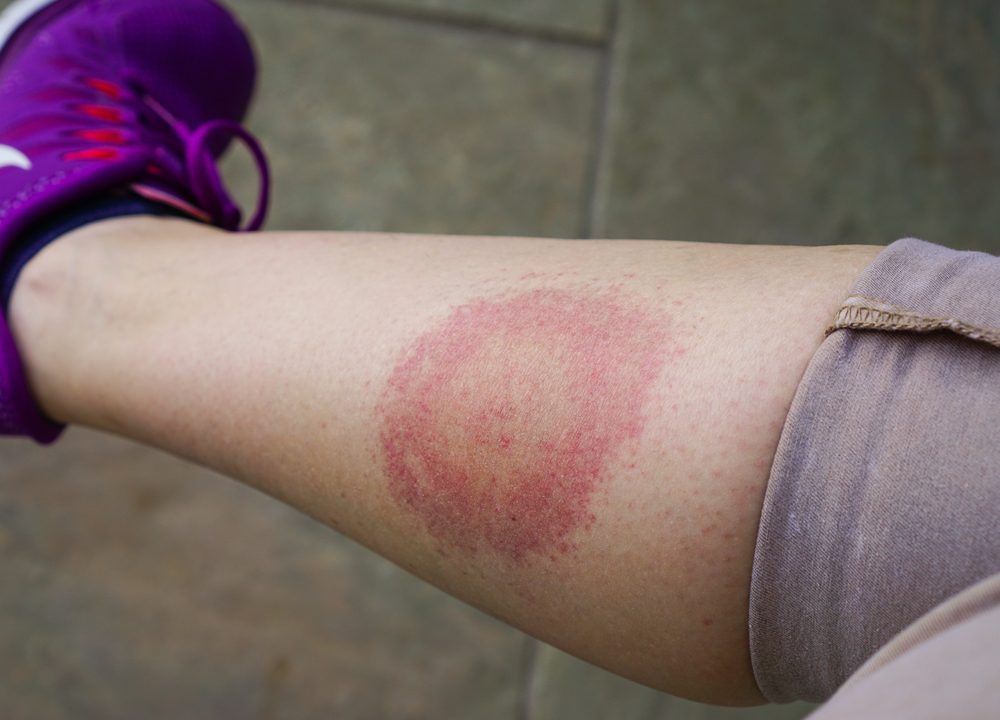 Borrelia rød ring på et skinneben