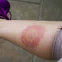 Borrelia rød ring på et skinneben