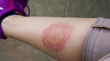Borrelia rød ring på et skinneben