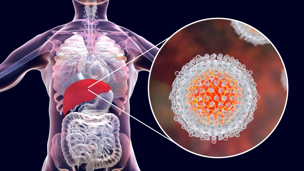 Hepatitis C-virus i forstørret kig på menneskets lever