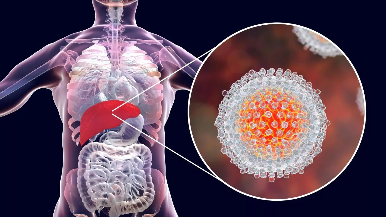 Hepatitis C-virus i forstørret kig på menneskets lever