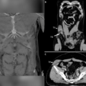 ct-scanning af mand hvis testikel er slået op i maven