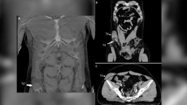 ct-scanning af mand hvis testikel er slået op i maven