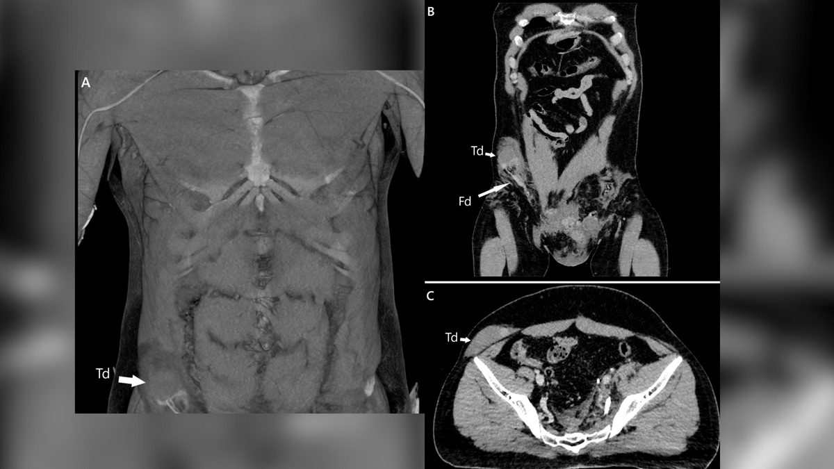 ct-scanning af mand hvis testikel er slået op i maven