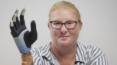 Kvinde med bionisk håndprotese