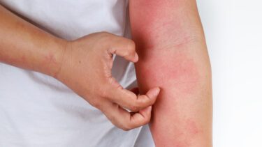 Klør på arm med eksem