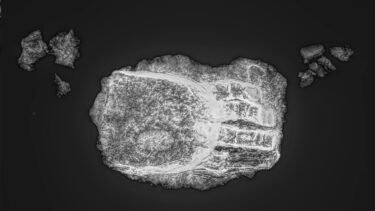 Røntgenfoto af skelettets håndprotese