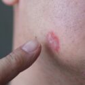 psoriasis-paa-kind-hos-mand